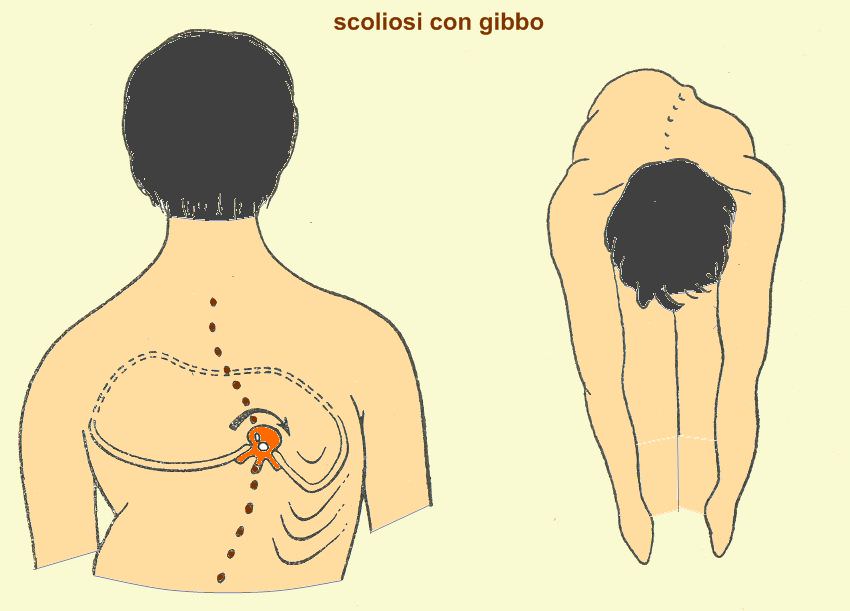 Scoliosi con gibbo